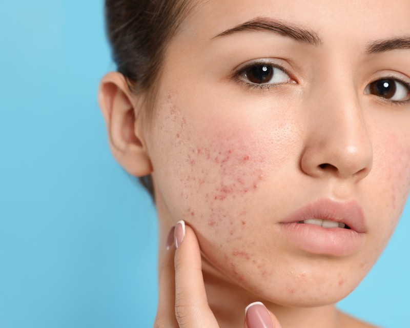 Acne Breakouts